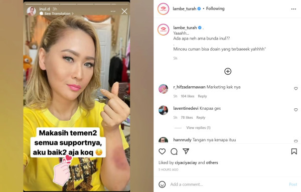 Tangan Lebam, Inul Daratista: Capek Berusaha Sabar Terus