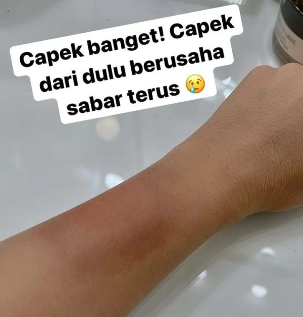 Tangan Lebam, Inul Daratista: Capek Berusaha Sabar Terus