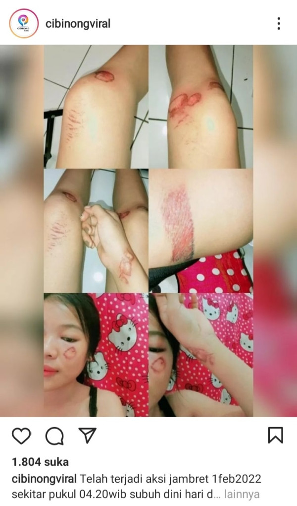 Pulang Kerja Jelang Subuh, Wanita Cantik Ini Penuh Luka Usai Dijambret