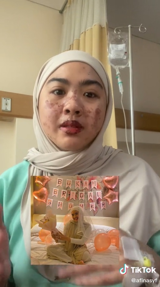 Perempuan Ini Tertular Covid-19 Usai Bridal Shower, Kulitnya Melepuh