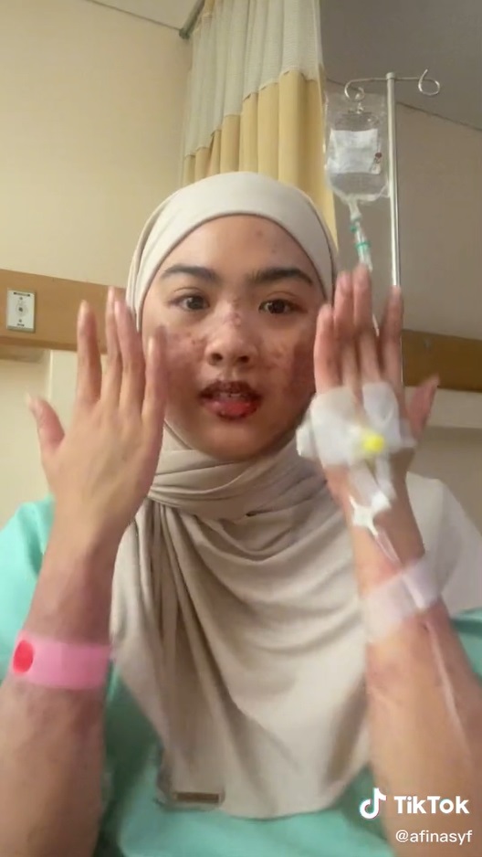 Perempuan Ini Tertular Covid-19 Usai Bridal Shower, Kulitnya Melepuh