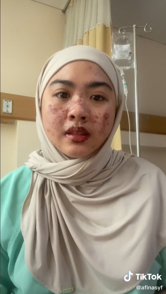 Perempuan Ini Tertular Covid-19 Usai Bridal Shower, Kulitnya Melepuh
