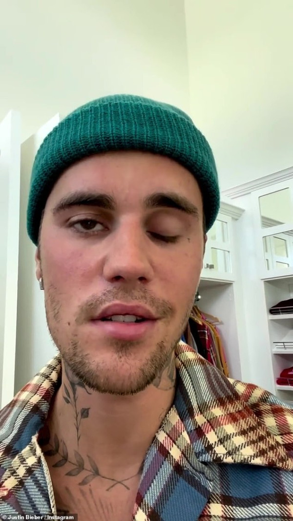 Justin Bieber Idap Ramsay Hut, Separuh Wajahnya Lumpuh
