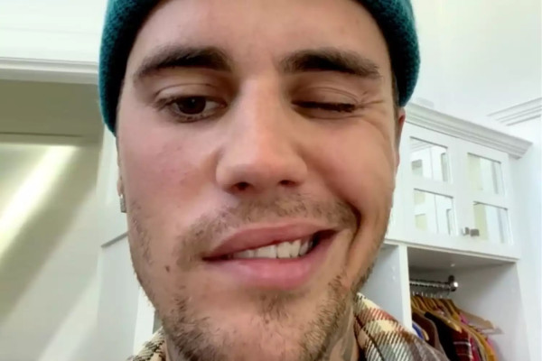 Justin Bieber Idap Ramsay Hut, Separuh Wajahnya Lumpuh