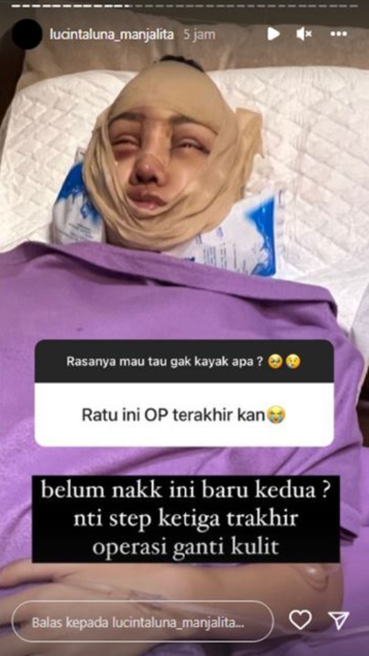 Usai Potong Leher dan Tulang Ekor, Lucinta Luna Akan Jalani Operasi Ganti Kulit