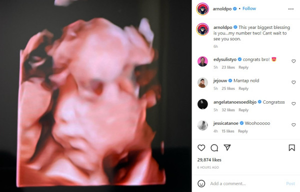Chef Arnold Unggah Foto USG, Umumkan Istri Hamil Anak Kedua