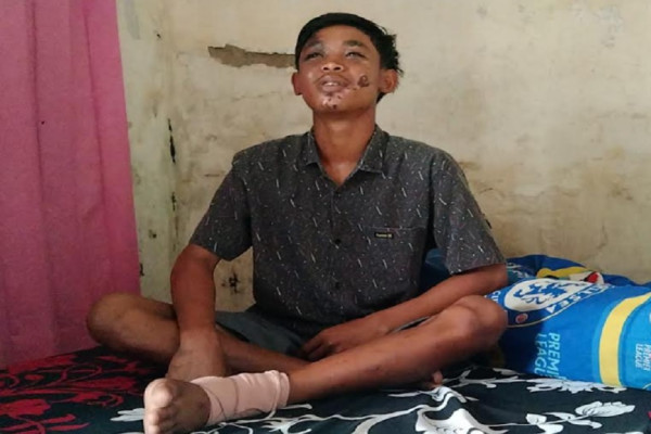 Kesaksian Nur Saguwanto Korban Tragedi Kanjuruhan, Kaki Patah Muka Melepuh dan Sesak Napas