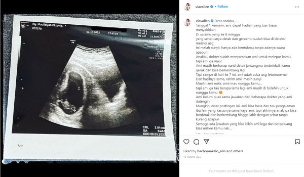 Via Vallen Umumkan Hamil 8 Minggu, Jantung Janin Tak Berdetak