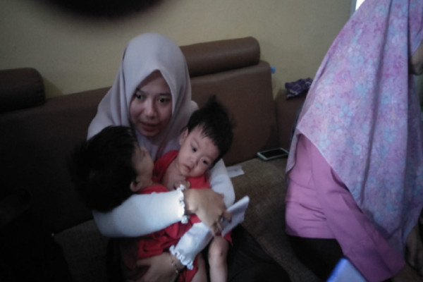 Operasi Kembar Siam Ayesha-Aleeya: Organ Liver Dempet dan Pembuluh Darah Menyilang