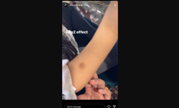 Arsy Hermansyah Tangannya Lebam Gegara Main Latto-latto, Atta Halilintar: Makanya Mainin yang Matic