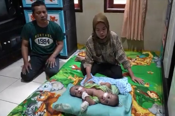 Dempet Dada dan Hati, Bayi Kembar Siam asal Lebak Banten Butuh Pertolongan