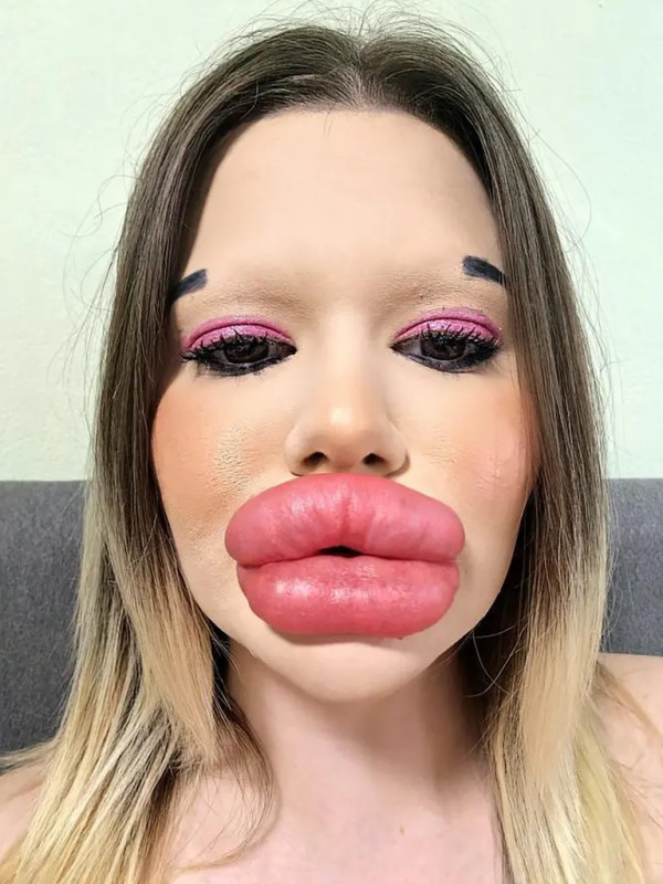 Pemilik Bibir Terbesar di Dunia Ingin Buat Rekor Baru Tulang Pipi