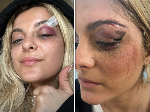 Waduh! Muka Bebe Rexha Dapat 3 Jahitan usai Dilempar HP saat Manggung