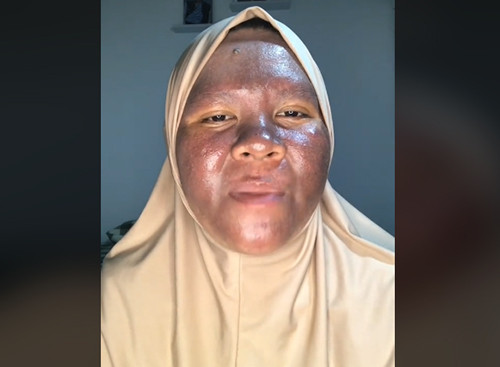 Wajah Wanita Ini Gosong Gegara Berhenti Pakai Krim Mengandung Merkuri, Yuk Kenali Bahayanya!