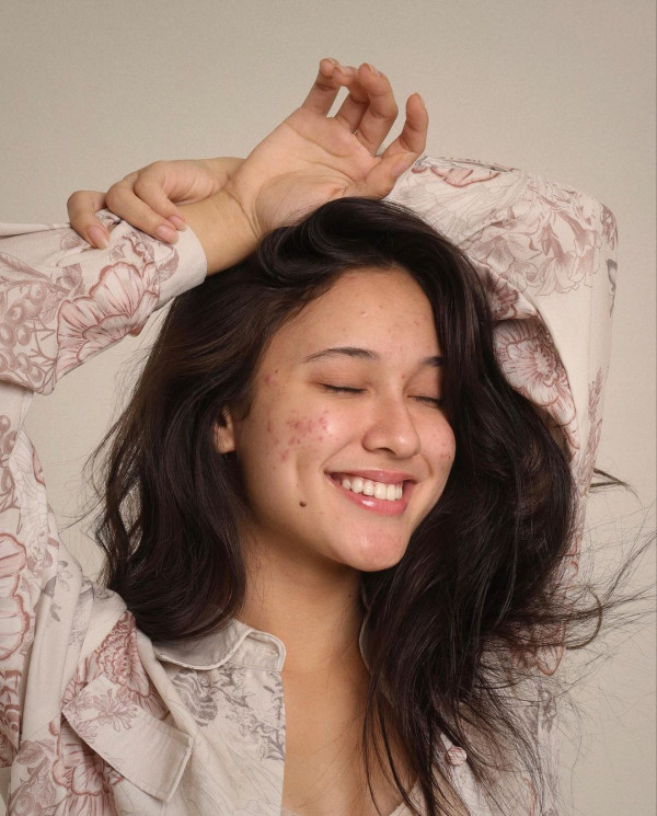 Yasmin Napper Malah Pede Pamer Banyak Jerawat di Wajah: You Are Beautiful