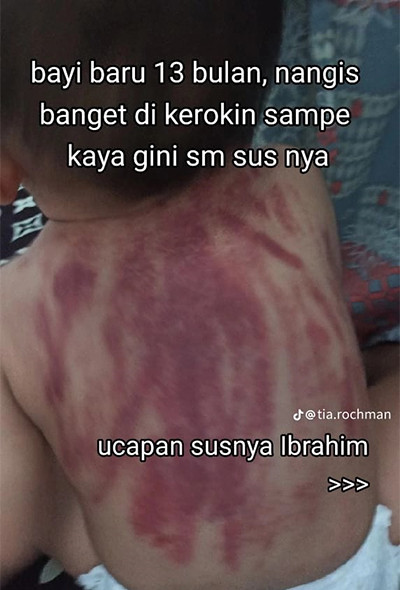 Viral! Anak 13 Bulan Dikeroki oleh Pengasuh, Bekas Merah-Merahnya Bikin Miris