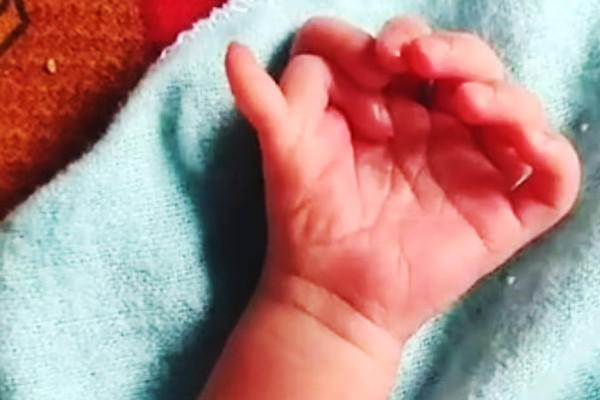 Bayi Perempuan Lahir dengan 26 Jari, Keluarga Sebut Titisan Dewi