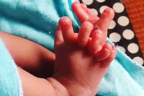 Bayi Perempuan Lahir dengan 26 Jari, Keluarga Sebut Titisan Dewi