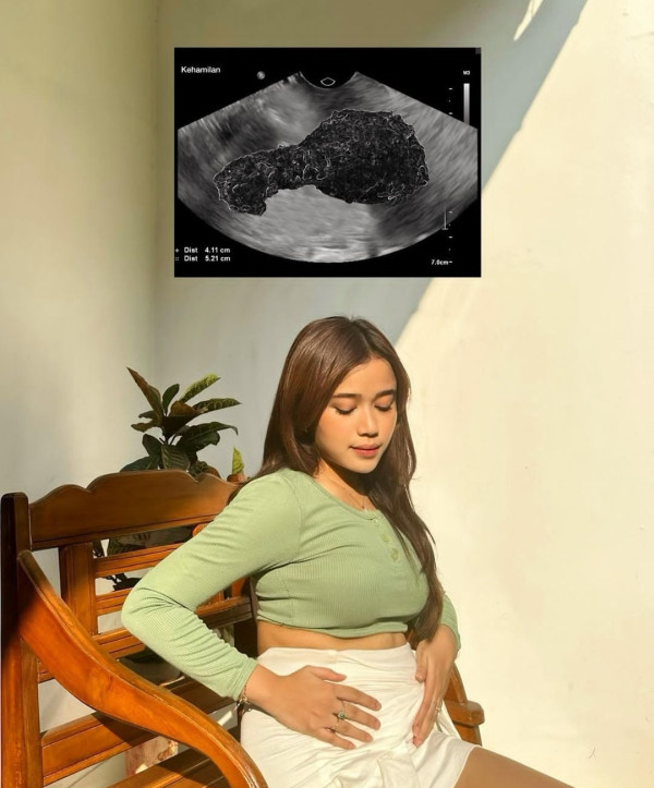 Brisia Jodie Sindir Netizen usai Dituding Hamil, Pamer Foto USG Bergambar Paha Ayam Goreng