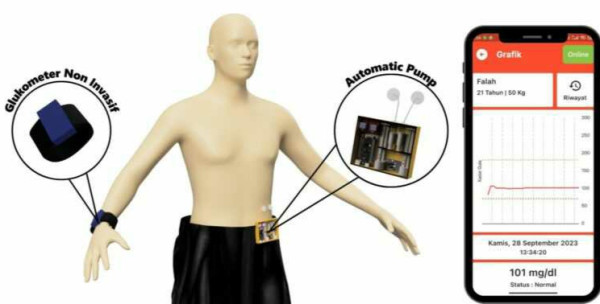 Mahasiswa UB Ciptakan Gelang Canggih Pengendali Diabetes GlukoSipp, Bisa Terhubung Smartphone