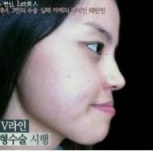 Viral! Istri Batal Diceraikan Suami Gegara Jadi Cantik usai Operasi Plastik