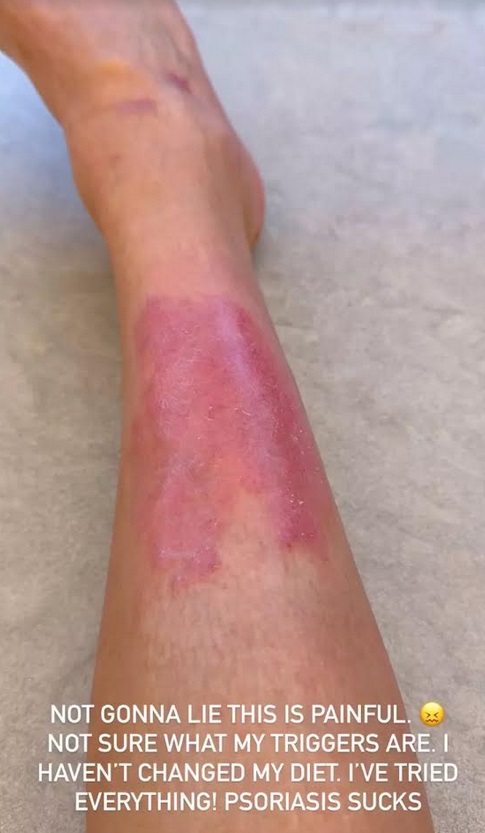 Penyakit Psoriasis Kim kardashian Kambuh Parah, Muncul Bercak Merah di Kulit