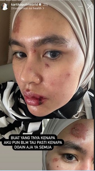 Kartika Putri Sedih Penyakitnya Disebut Kena Azab, Wajah dan Lidah Penuh Luka