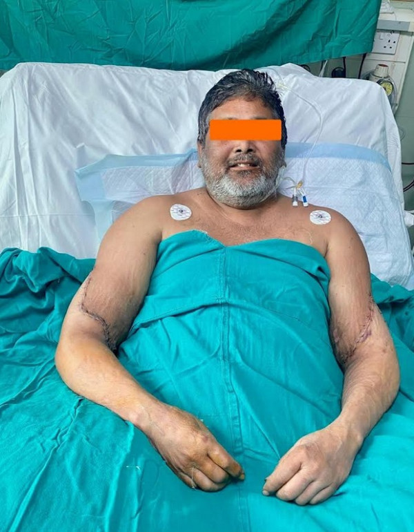 Kisah Pelukis India Berhasil Transplantasi Tangan Pertama, Dapat Organ dari Seorang Wanita