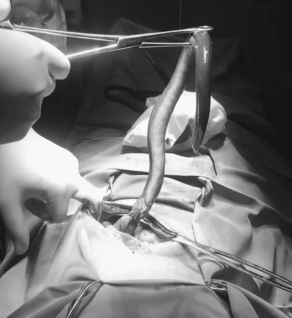 Viral! Dokter Keluarkan Belut Hidup dari Perut Pria, Bikin Usus Berlubang