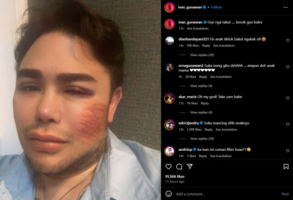 Ivan Gunawan Bagikan Foto Wajah Lebam, Singgung soal Niat Balas Dendam