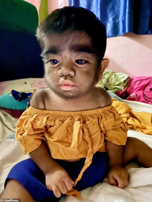 Anak Ini Idap Sindrom Manusia Serigala, Sekujur Tubuhnya Dipenuhi Bulu