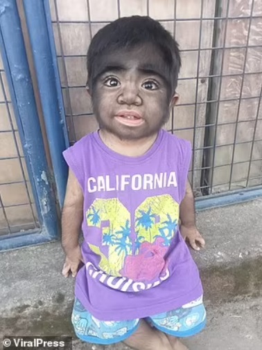 Anak Ini Idap Sindrom Manusia Serigala, Sekujur Tubuhnya Dipenuhi Bulu