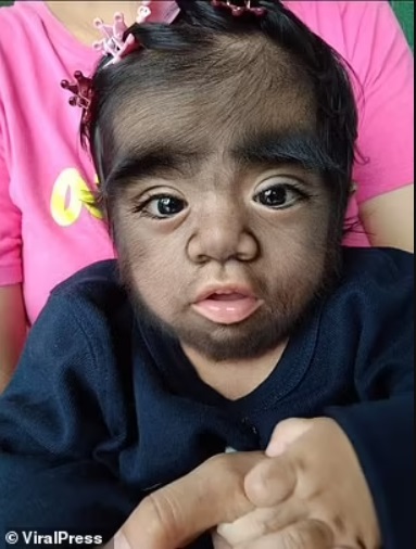 Anak Ini Idap Sindrom Manusia Serigala, Sekujur Tubuhnya Dipenuhi Bulu
