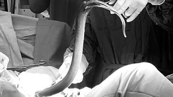 Ngeri! Pria India Alami Nyeri Perut Hebat Akibat Masukkan Belut Hidup ke Anus, Diduga demi Kepuasan Seksual