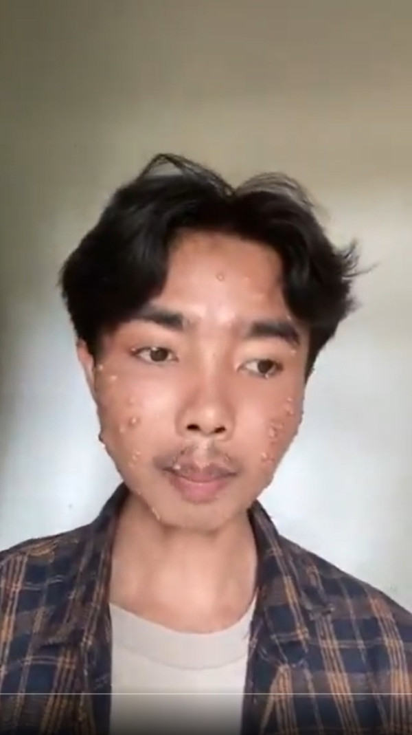 Pria Ini Idap Penyakit Kulit Akibat Pakai Baju Thrifting Tanpa Dicuci, Kenali Gejalanya