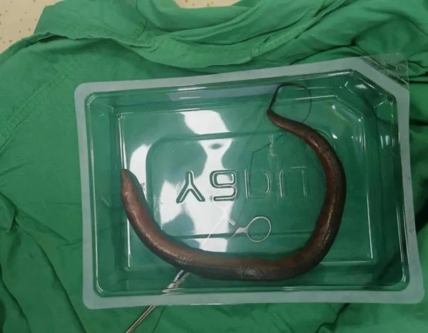 Heboh! Dokter Temukan Belut Hidup di Rongga Perut Pria, Diduga Masuk Lewat Usus