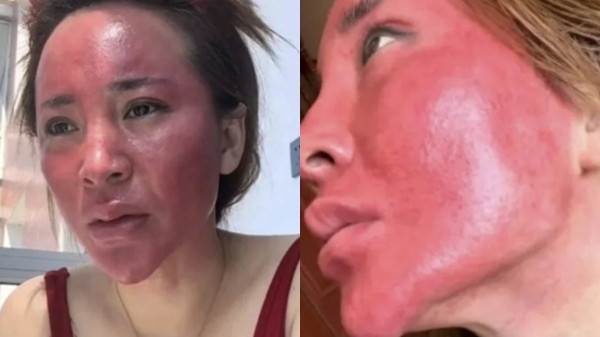 22 Tahun Tak Bersihkan Makeup, Perempuan Ini Derita Ruam Parah di Wajah