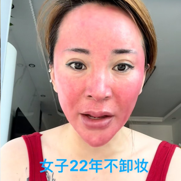 22 Tahun Tak Bersihkan Makeup, Perempuan Ini Derita Ruam Parah di Wajah