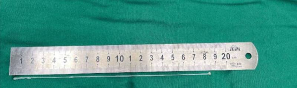 Akibat Telan Organ Ular Mentah, Cacing 18 Cm Bersarang di Otak Pria Ini